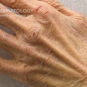 IrritantDermatitis_C_Adusumilli_3.jpg