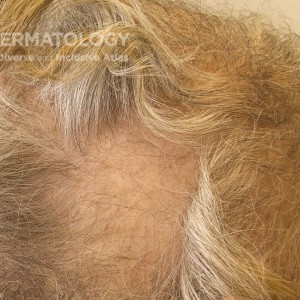 Alopecia Areata_B_Scalp_Side.jpg