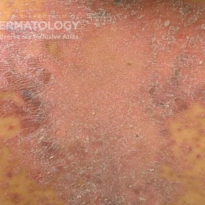 Atopic Dermatitis Type D_Back.jpg