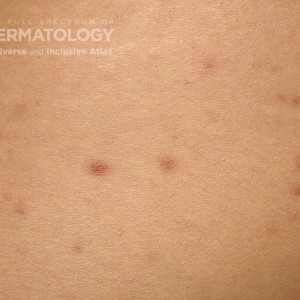Mastocytosis_5 type c_Friedmancloseup.jpg