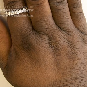 Ezekwe_E_Atopic Dermatitis_Hands.jpg