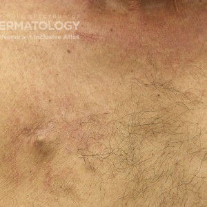 AtopicDermatitis_C_Adusumilli_chest.jpg