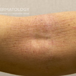 AtopicDermatitis_C_Adusumilli15_insidearm.jpg