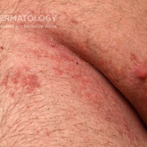 Candidiasis_A_Intertrigo_Closeup.jpg