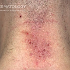 nummulardermatitis_a_carrington_4.jpg