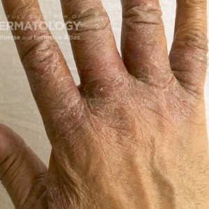 AtopicDermatitis_C_Adusumilli_Hand1.jpg