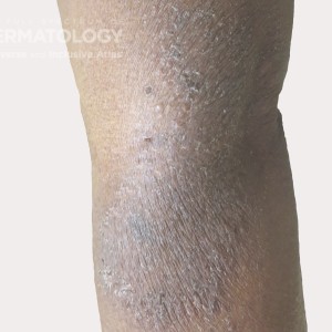 atopic dermatitis type e_.jpg