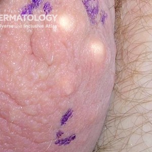 Scrotal_Calcinosis_DIR60315.jpg