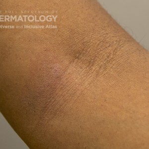 Atopicdermatitis_d_Adusumilli2.jpg