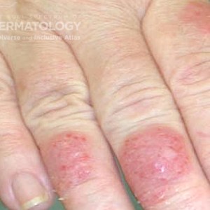 Allergic Contact Dermatitis_DIR 60176.jpg