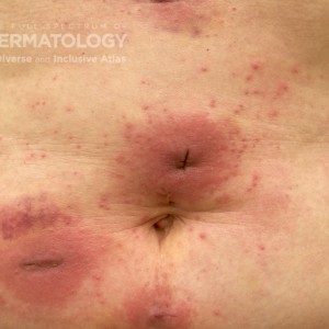 AllergicContactDermatitis_B_Adusumilli2.jpg