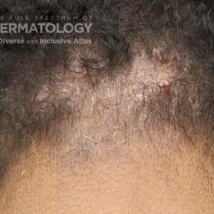 Acne Keloidalis Nuchae_D_scalp4.jpg