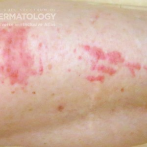 allergic contact dermatitis type A leg.jpg