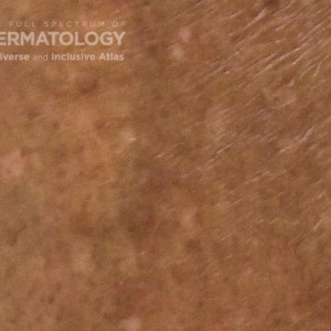 Idiopathic Guttate Hypomelanosis_Legcloseup_D_2.jpg