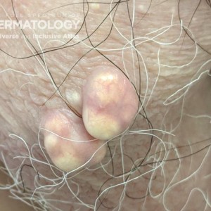 Scrotal_Calcinosis_DIR61469.jpg