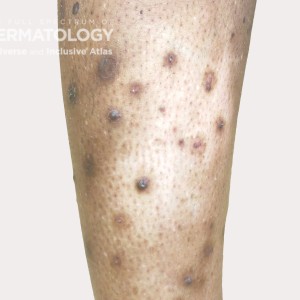 prurigo nodularis with hypopigmentation tyoe D leg3_.jpg