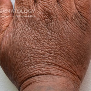 Atopic_Derm_Hand_E.jpg