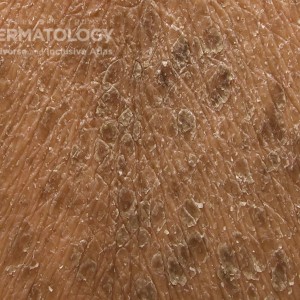 Icthyosis_C_back6closeup.jpg